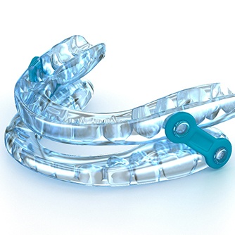 Close-up of oral appliance used to treat sleep apnea