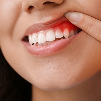 A woman revealing her red and inflamed gums