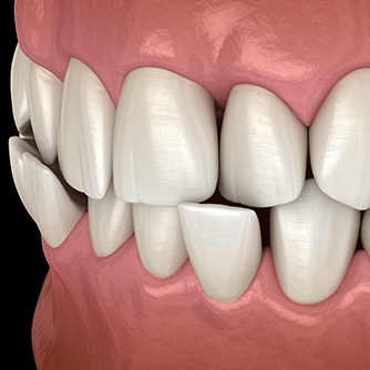 a digital illustration showing crowded teeth