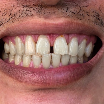 a smiling person with gaps between his two front teeth 