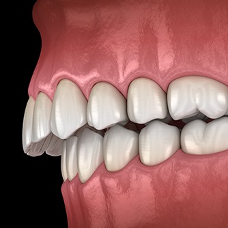 a digital illustration depicting overbite