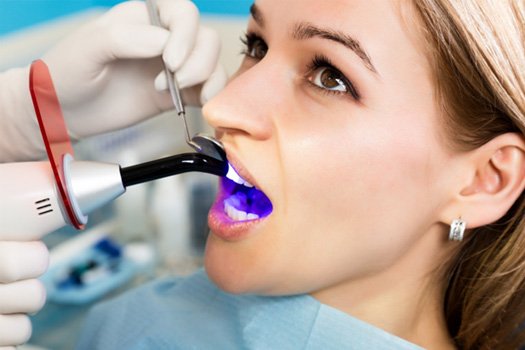 UV light hardening woman’s dental bonding