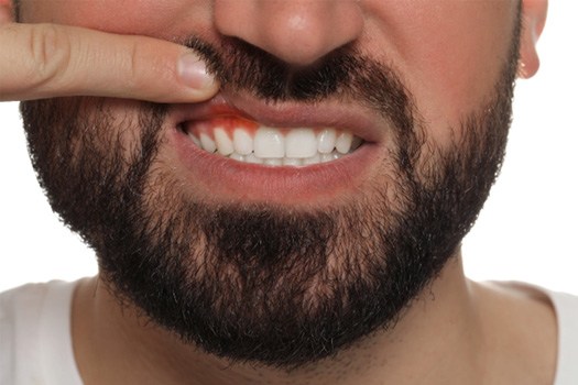 Nose-to-neck view of woman in sweater pulling down lower lip to reveal darkened gum tissues