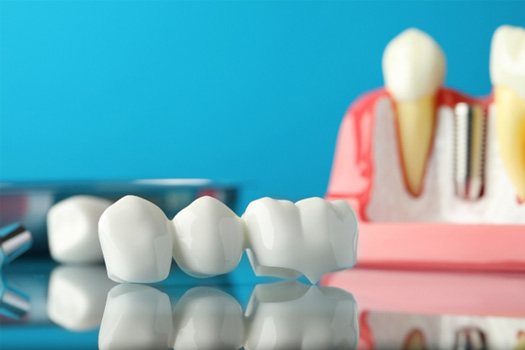 Dental bridge and implant on reflective surface with blue background