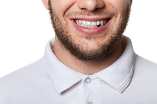 Replace one or more missing teeth near Tuckahoe