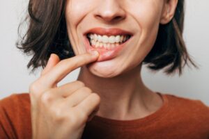Woman pulling down lip to show off gums.